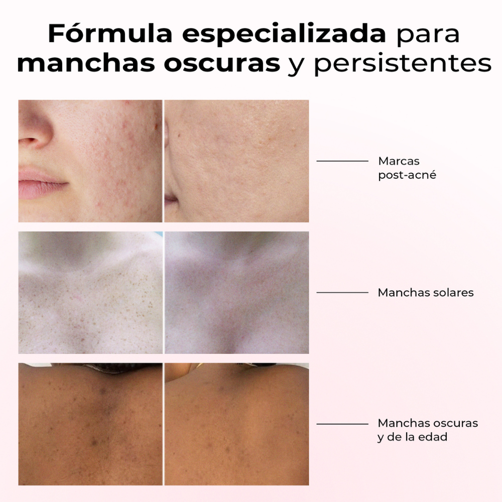 Resultados del sérum Lumen Drop en manchas oscuras: post-acné, solares y de la edad