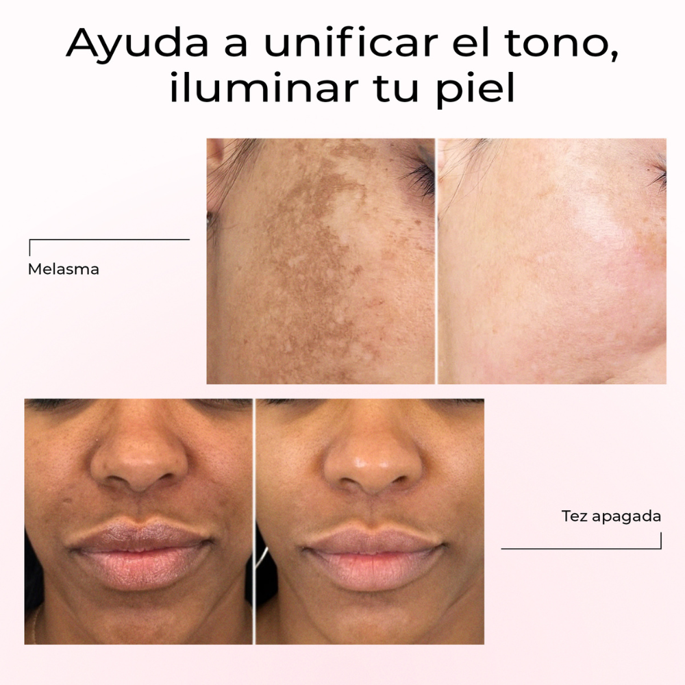 Resultados antes y después del sérum Lumen Drop en melasma y tez apagada – piel más uniforme y luminosa
