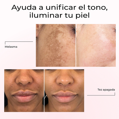 Resultados antes y después del sérum Lumen Drop en melasma y tez apagada – piel más uniforme y luminosa